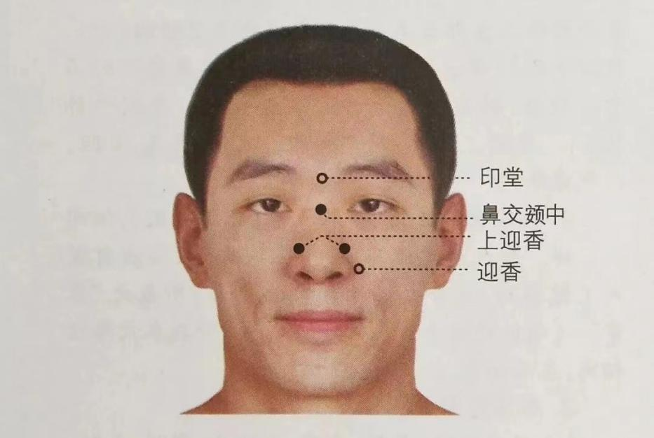 2.上迎香穴位于鼻翼软骨与鼻甲骨交界处，即鼻唇沟上端。3.印堂穴位于两眉