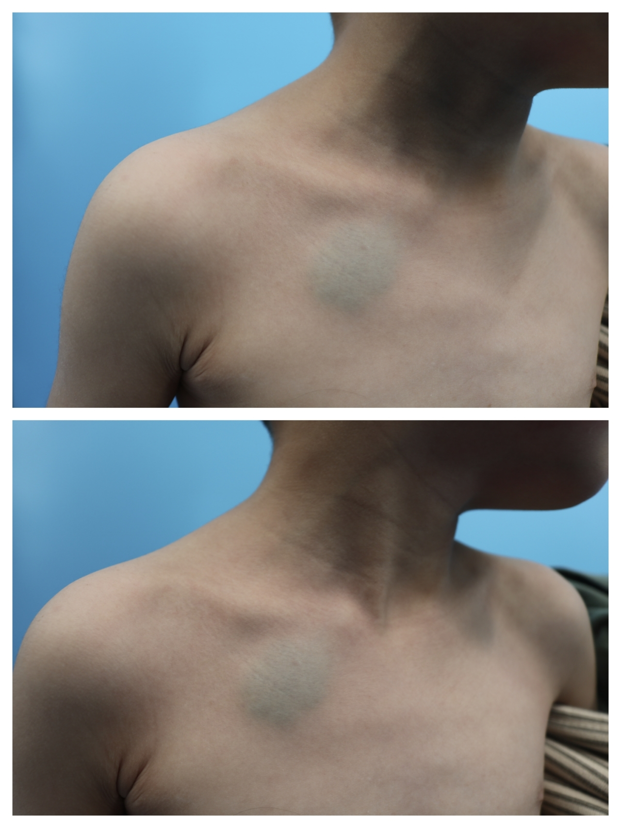 血管瘤不治疗会自行消退吗